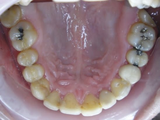 將長期累積的牙結石統統去除，建立乾净的口腔環境