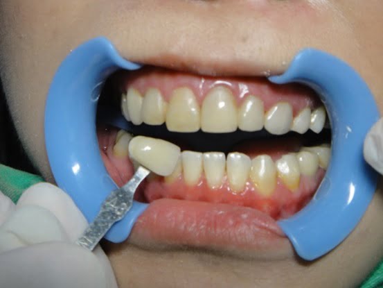 洗完牙之後，牙齒的比色結果